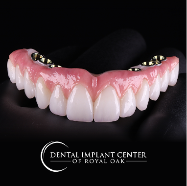 Hybrid Implant Bridge