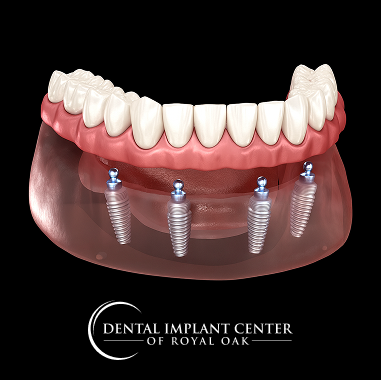 Zirconia Implant Bridge