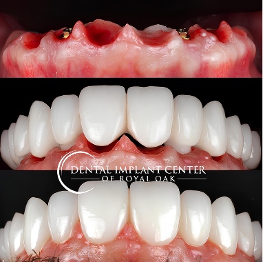 Porcelain Implant Bridge